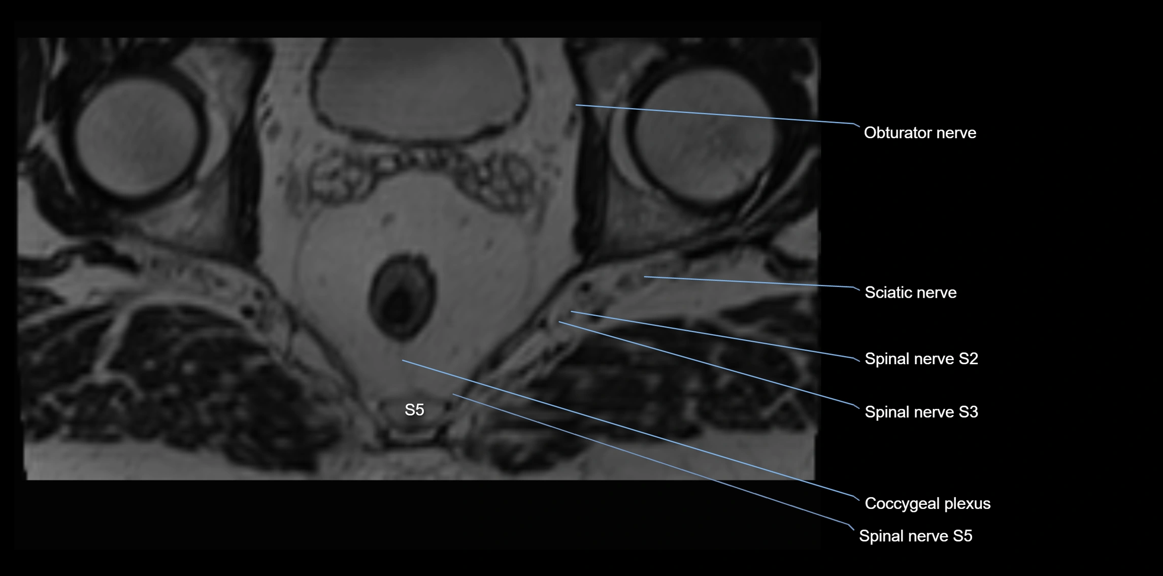 MR lumbosacral plexus axial cross sectional anatomy 3T  radiology  image-img-1008001-00117.webp